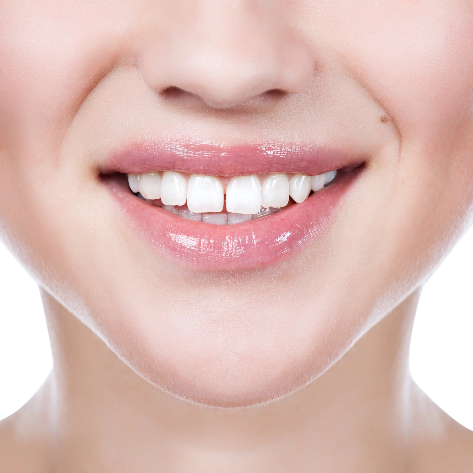 Diastema (Diş Arası Boşluk) Tedavisi
