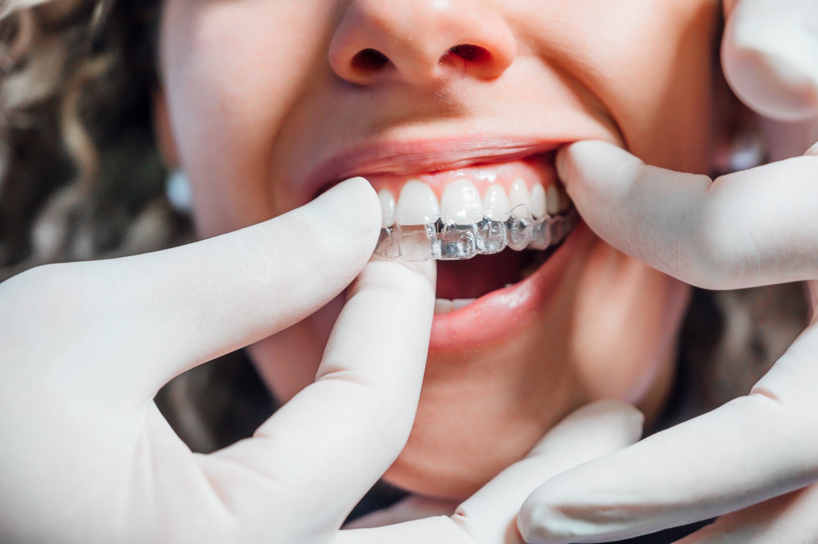 Invisalign (Şeffaf Plak Tedavisi)